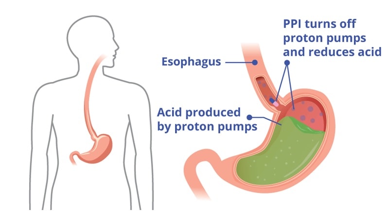 PPI reduces tomach acid and nitric oxide production