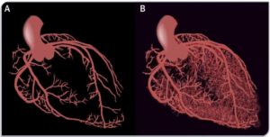 Heart with ischemic, non-obstructive coronary artery disease vs healthy heart