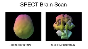 SPECT brain scan - healthy brain vs Alzheomers brain
