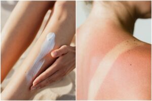 Applying sunscreen on legs vs sunburn on back